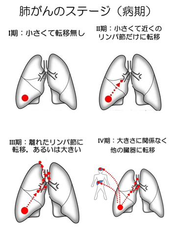 肺がんのステージ（病期）