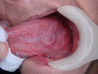 初期舌がん