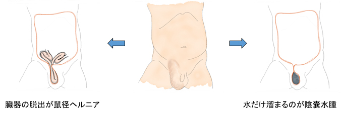 陰嚢水腫と鼠径ヘルニアの違い